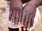 Paciente com Monkeypox