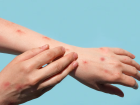 Lesões de pele estão entre os sintomas mais comuns da mpox  