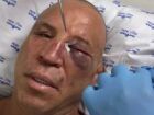 Wanderlei Silva sofre fratura no nariz após agressão de filho de Popó e é levado ao hospital