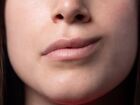 O que é a síndrome de Bell, popularmente conhecida como paralisia facial.