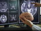 OMS alerta que maioria dos países não está preparada para enfrentar avanço de doenças neurológicas
