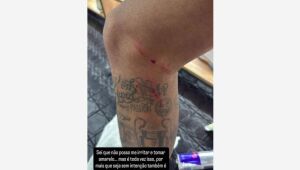 Neymar posta foto da perna machucada após duelo com o Fluminense.