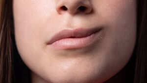 O que é a síndrome de Bell, popularmente conhecida como paralisia facial.