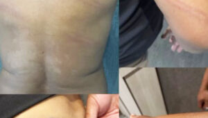 O ex-jogador Perdigão divulgou imagens de escoriações pelo corpo após ser agredido por policial militar