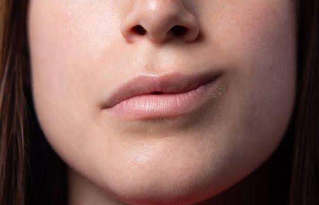 O que é a síndrome de Bell, popularmente conhecida como paralisia facial