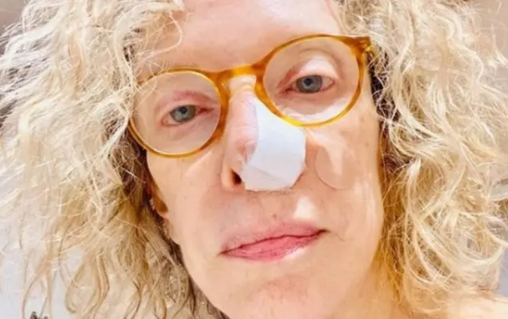 Marília Gabriela fez uma cirurgia de retirada de um câncer de pele na narina esquerda