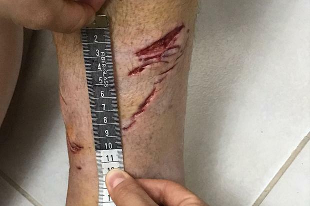 Ataque de tubarão em Ubatuba