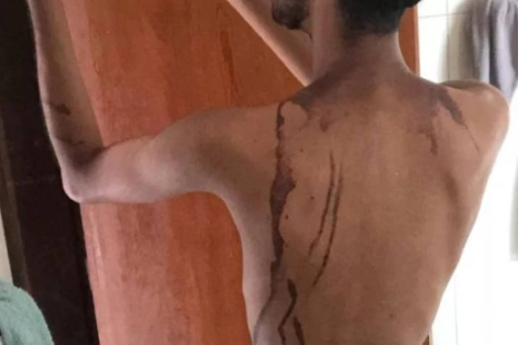 Durante o trote, os acusados teriam jogado um produto nos corpos das vítimas, o que teria ocasionado as queimaduras