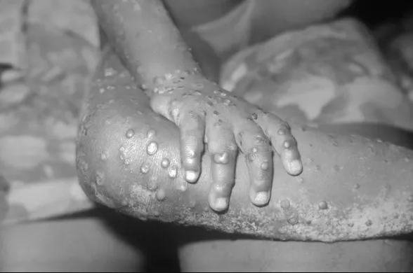 Agora analisaremos o vírus mais de perto e examinaremos se envolve uma variante mais contagiosa, disse Lauterbach, segundo a Reuters