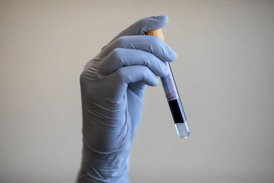 Saúde busca casos de hepatite A para desenvolver estratégias de prevenção da doença