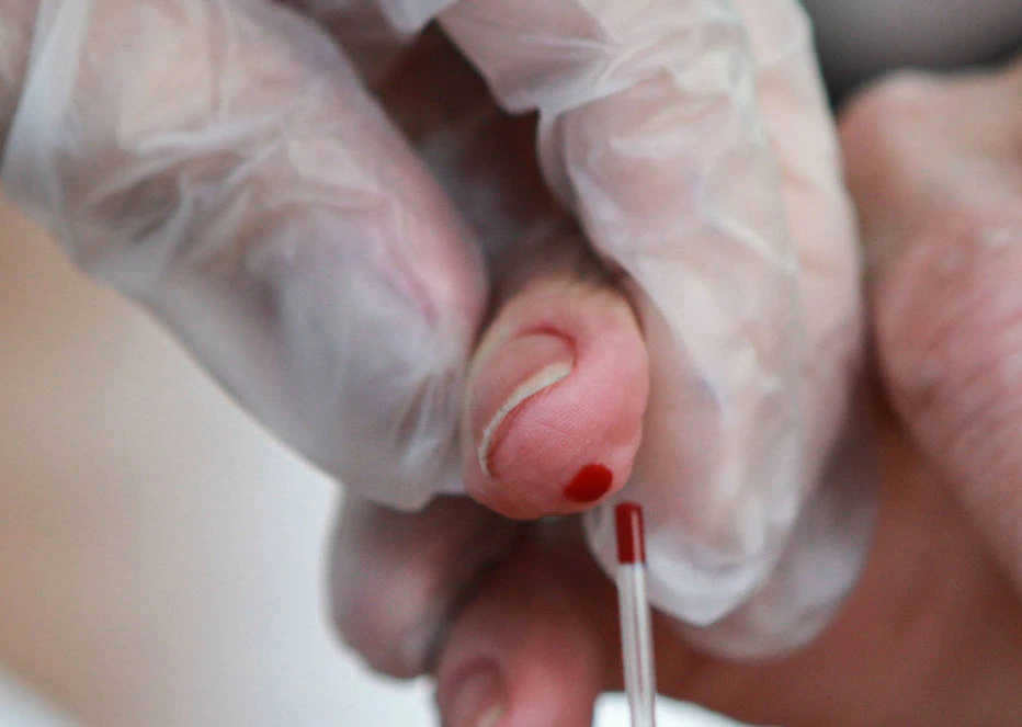 O diagnóstico da hepatite C é feito com a coleta de uma gota de sangue. Pessoas realizaram o exame de forma gratuita, em frente à Fiesp, na Avenida Paulista, em 2018