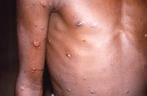 Paciente com a Mpox, antiga varíola dos Macacos