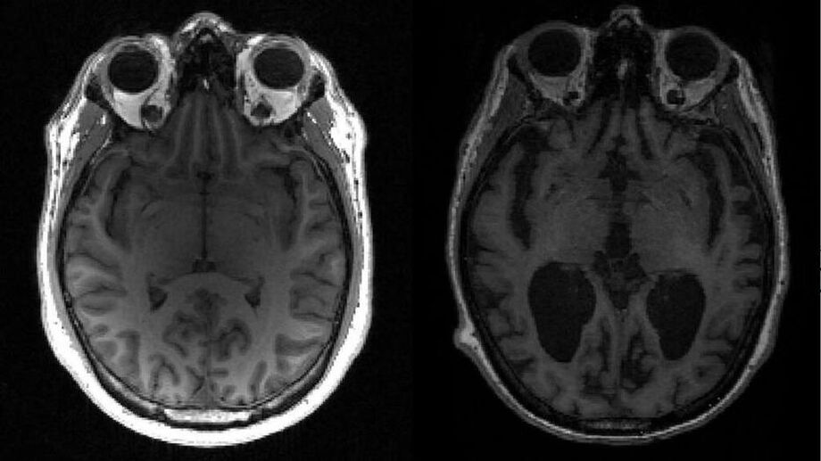 Ressonância magnética de um cérebro saudável (esquerda) e outro com o Alzheimer (direita)