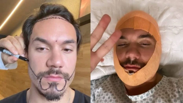 Ex-BBB Elizer mostra procedimento de implante de barba e cabelo