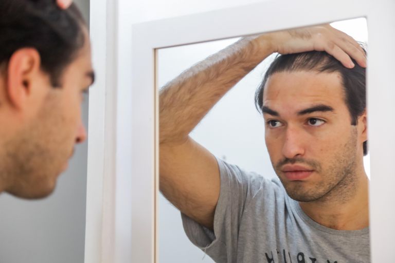 O minoxidil, medicamento usado para tratamento da calvície, passou a ser receitado na forma de comprimidos para combater a queda de cabelo