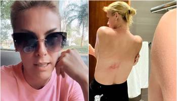 Ana Hickmann revelou que machucou as costas e mostrou o resultado publicando uma foto nos stories