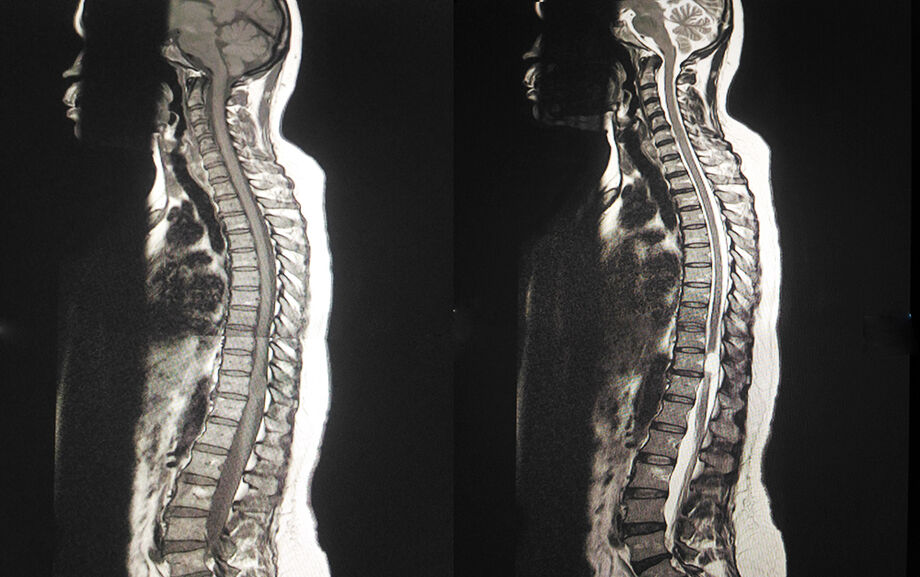 Atrofia muscular espinhal