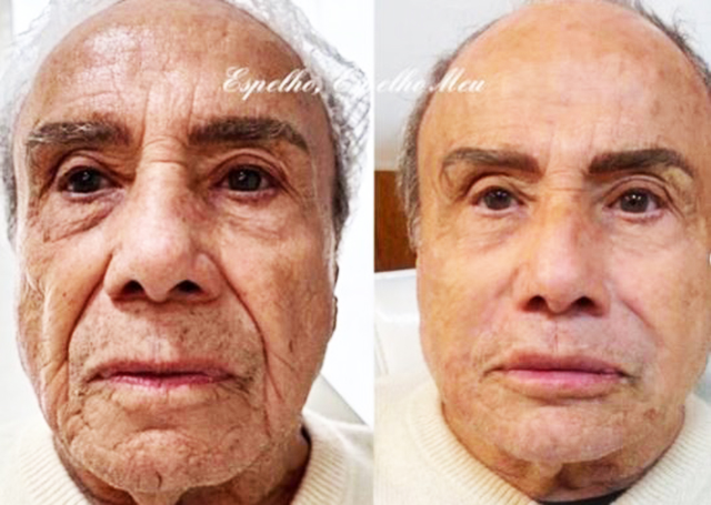 Stênio Garcia após o procedimento