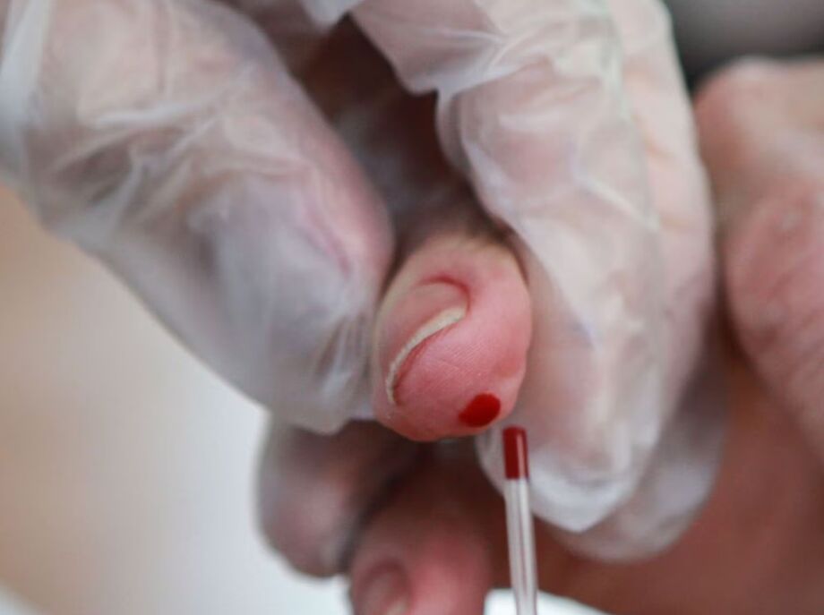 O SUS disponibiliza diagnóstico e tratamento para Hepatite B.