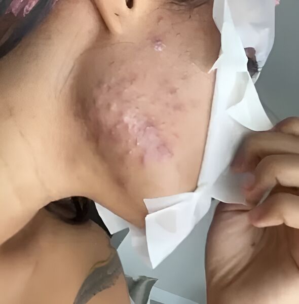 No começo do ano, a cantora e compositora Flay mostrou em suas redes sociais os efeitos do chip da beleza em sua pele. Ela disse que não foi informada sobre os efeitos colaterais do implante pelo seu médic