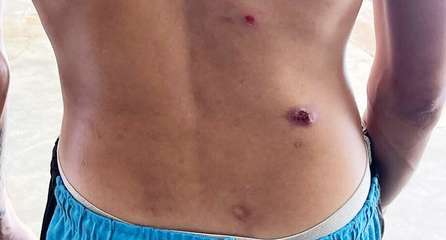 Internos mostram as feridas pelo corpo