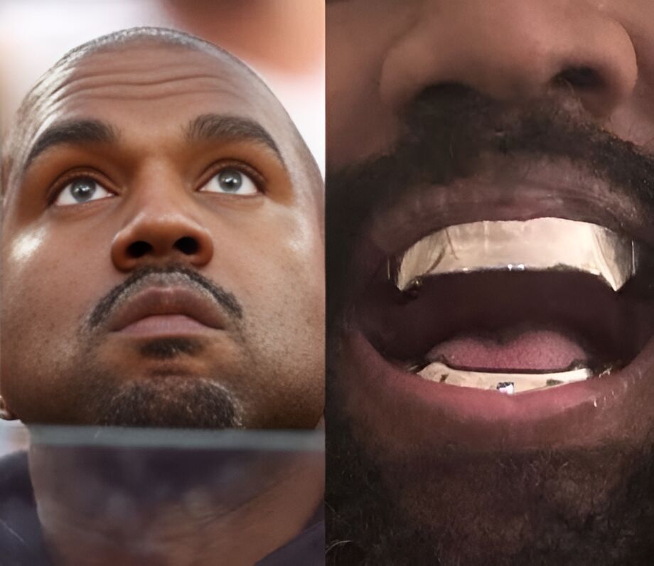 Kanye West coloca prótese de titânio nos dentes
