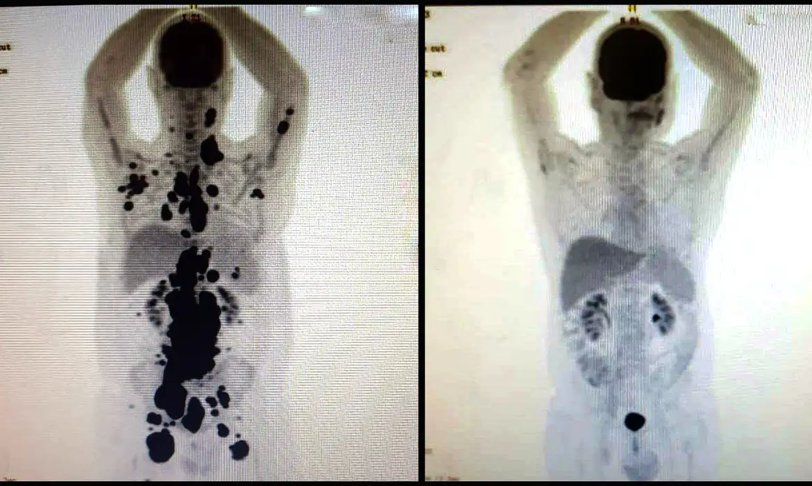 cancer antes_depois