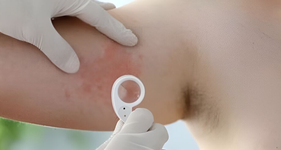 A psoríase leva ao surgimento de placas vermelhas na pele, decorrentes de um processo inflamatóri