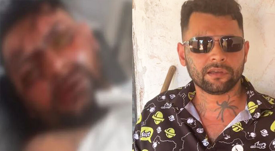 Leandro foi atingido por soda cáustica em fevereiro do ano passado