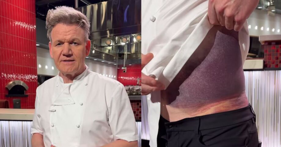 Chef famoso Gordon Ramsay mostra hematoma após sofrer acidente de bicicleta.