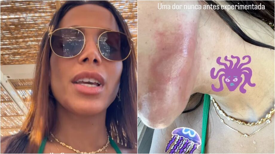 Cantora Anitta é atacada por água-viva