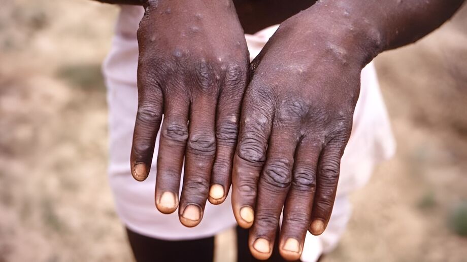 Paciente com Monkeypox