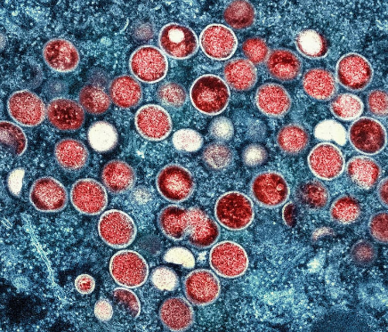 Suécia confirma primeiro caso de variante da Mpox fora da África