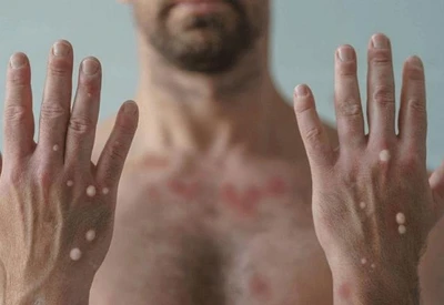 Infecção viral pode ser confundida com surto de herpes ou sífilis e está sob observação da Organização Mundial de Saúde