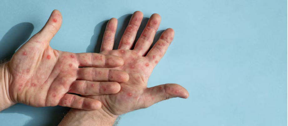 Male hands with Monkeypox rash. Patient with MonkeyPox viral disease. Close Up of Painful rash, red spots blisters on the skin. Human palm with Health problem. Banner, copy space. Allergy, dermatitis (não usar depois de 12 de setembro de 2024.