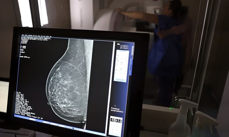 Ministério da Saúde amplia ações para facilitar diagnóstico e tratamento do câncer de mama no SUS
