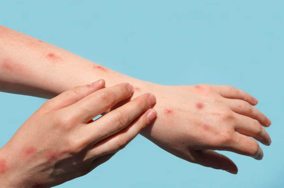 Lesões de pele estão entre os sintomas mais comuns da mpox