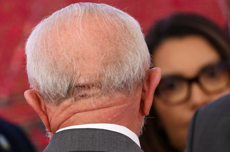 Pontos na nuca de Lula, decorrentes de acidente doméstico no domingo, 19 de outubro