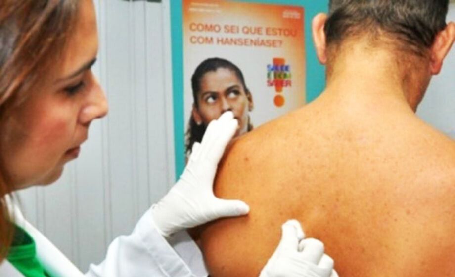 MS registra alta nos casos de hanseníase e aposta na capacitação de agentes e profissionais da saúde para conter avanço da doença.