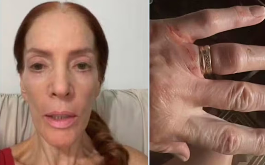 A médica Marília de Godoy Dalprá foi vítima de ação violenta de criminosos no Parque Continental, em SP. Ela exibiu a mão machucada pelas criminosos.
