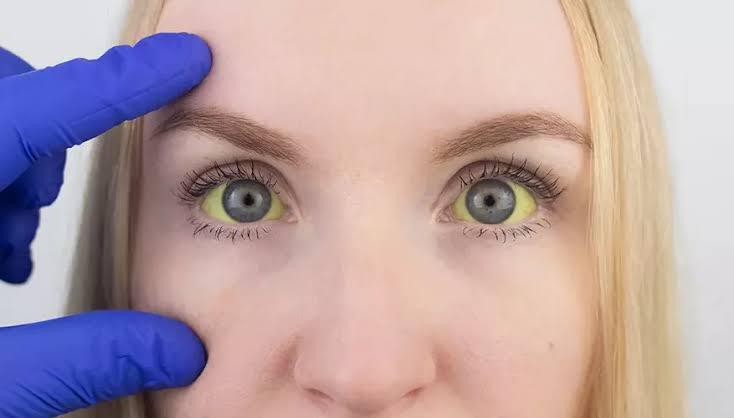 Um dos sintomas mais conhecidos é a icterícia, esse amarelado nos olhos