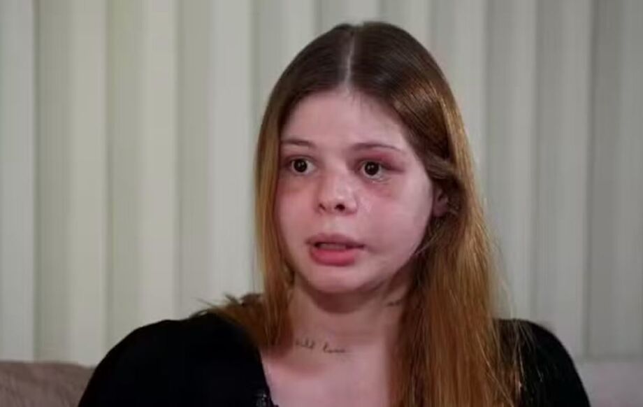 Samira Khouri, vítima de agressões brutais por parte de seu ex-namorado, compartilha sua história e as sequelas da violência em entrevista ao programa Fantástico.