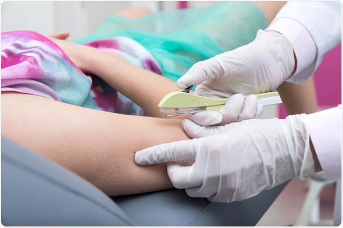 Implanon é um método contraceptivo hormonal de longa duração aplicado sob a pele