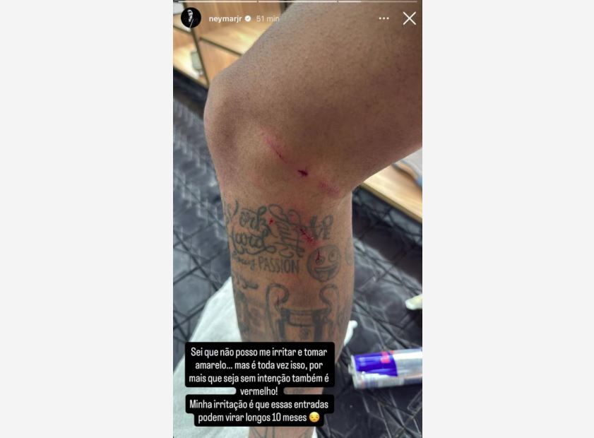 Neymar posta foto da perna machucada após duelo com o Fluminense.
