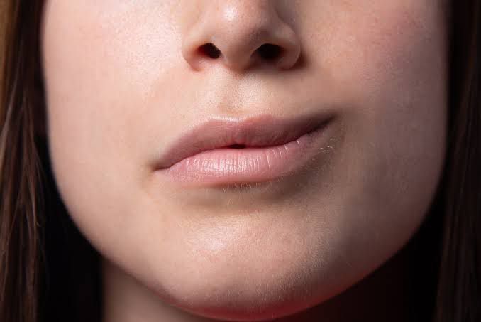 O que é a síndrome de Bell, popularmente conhecida como paralisia facial.