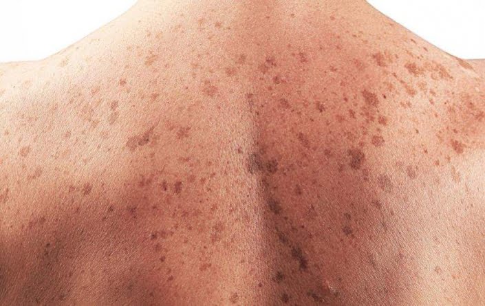 Dermatologistas voluntários realizarão triagens gratuitas contra o câncer de pele em MS no dia 13 de dezembro