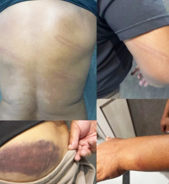 O ex-jogador Perdigão divulgou imagens de escoriações pelo corpo após ser agredido por policial militar