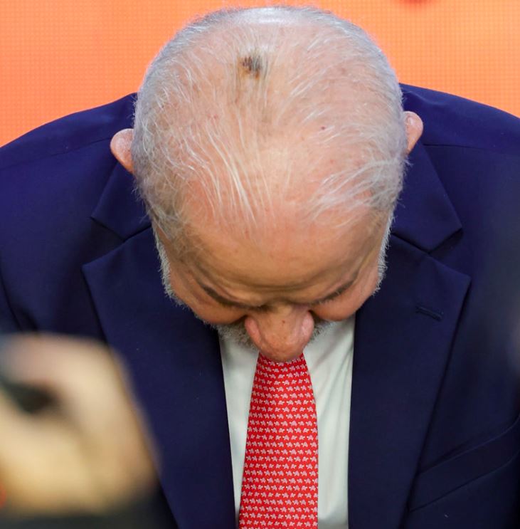 Presidente Lula passou por cauterização para tratar queratose no couro cabeludo.