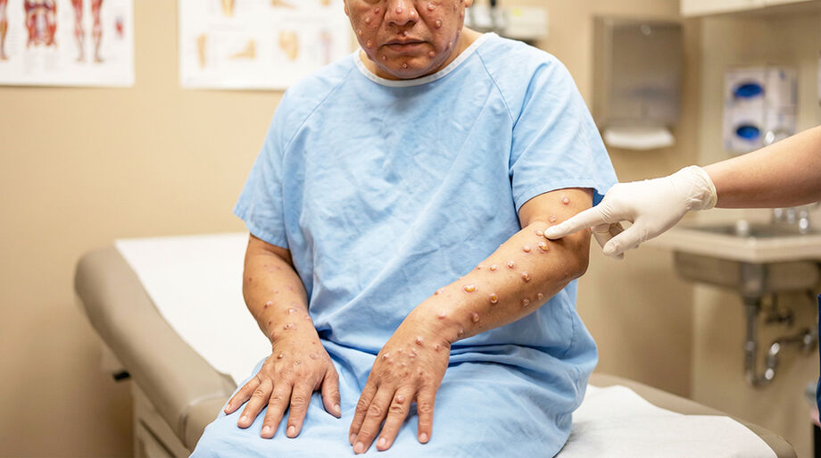 Profissional de saúde analisa amostras de mpox em laboratório; OMS reconheceu nova cepa recombinante do vírus, mas manteve risco baixo para a população em geral.