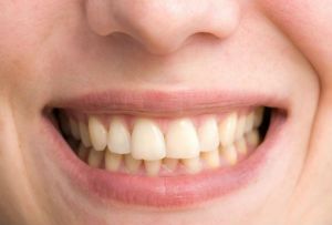 Excesso de acidez na boca pode causar erosão dentária